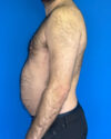 Gynecomastia case #3988