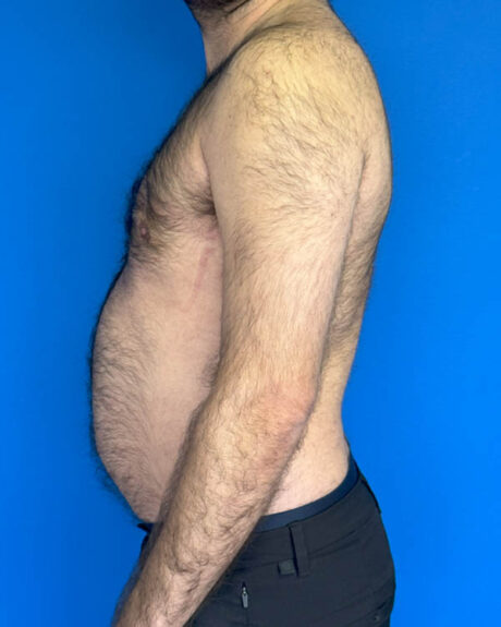 Gynecomastia case #3988