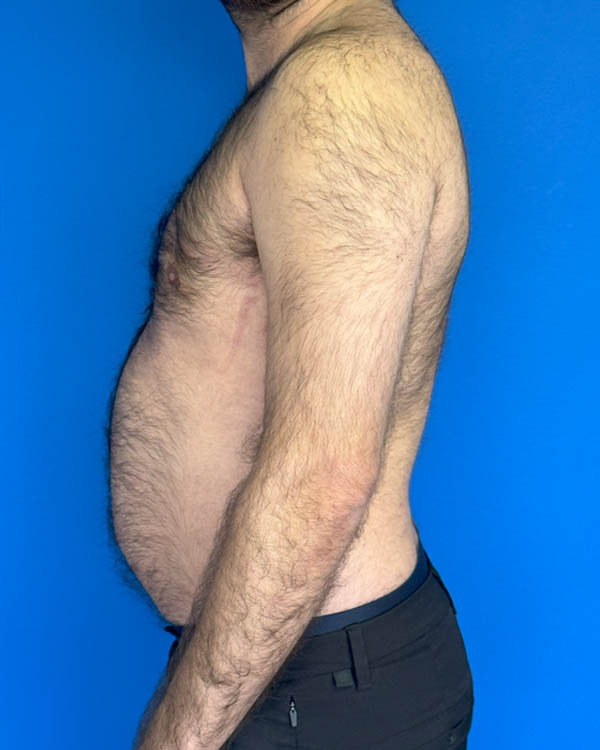 Gynecomastia case #3988