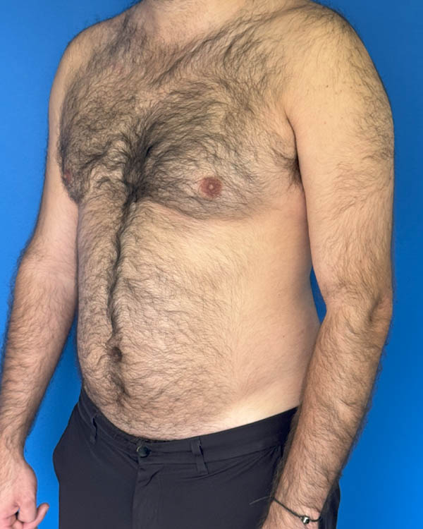 Gynecomastia case #3988