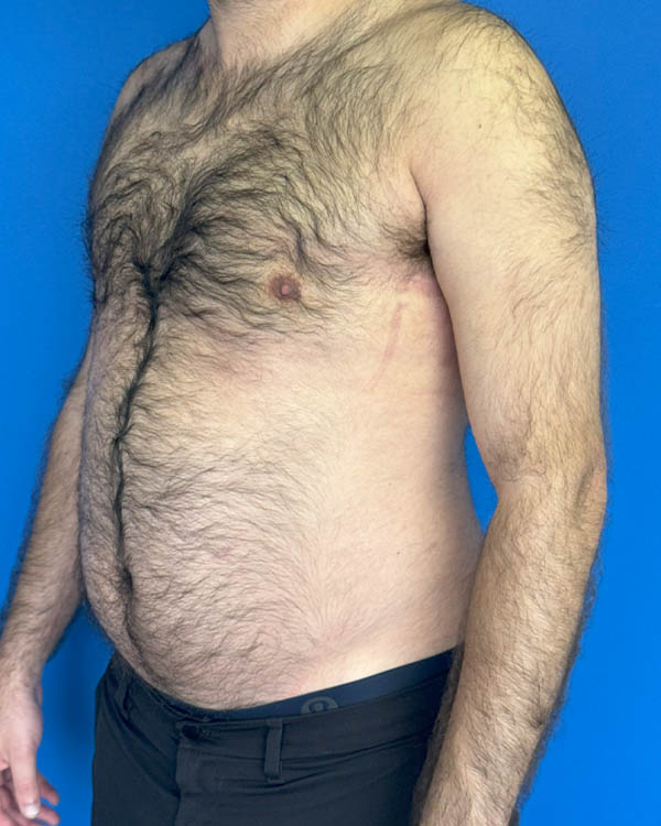 Gynecomastia case #3988