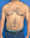 Gynecomastia case #3999