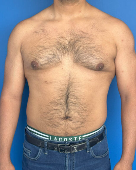 Gynecomastia case #3999