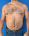 Gynecomastia case #3999