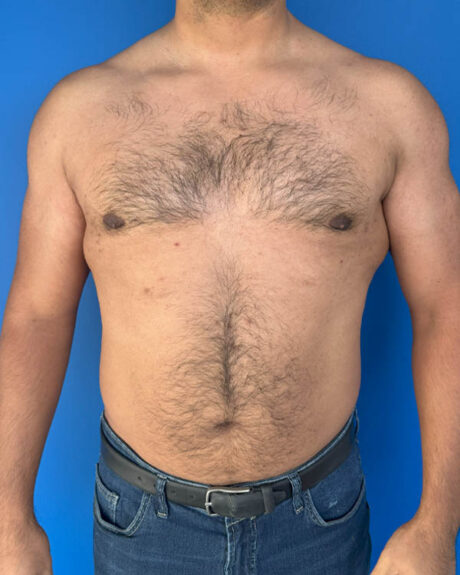 Gynecomastia case #3999