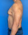 Gynecomastia case #3999