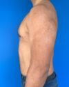 Gynecomastia case #3999
