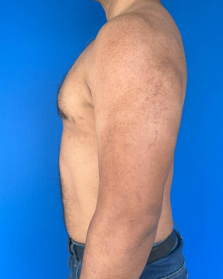 Gynecomastia case #3999