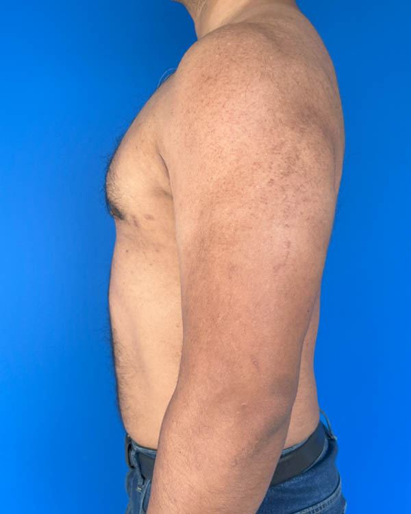 Gynecomastia case #3999