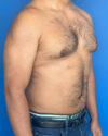 Gynecomastia case #3999