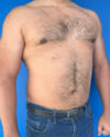 Gynecomastia case #3999