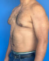 Gynecomastia case #3999