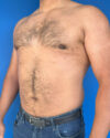 Gynecomastia case #3999