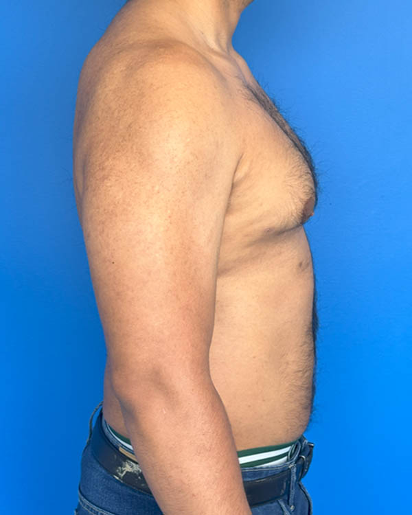 Gynecomastia case #3999