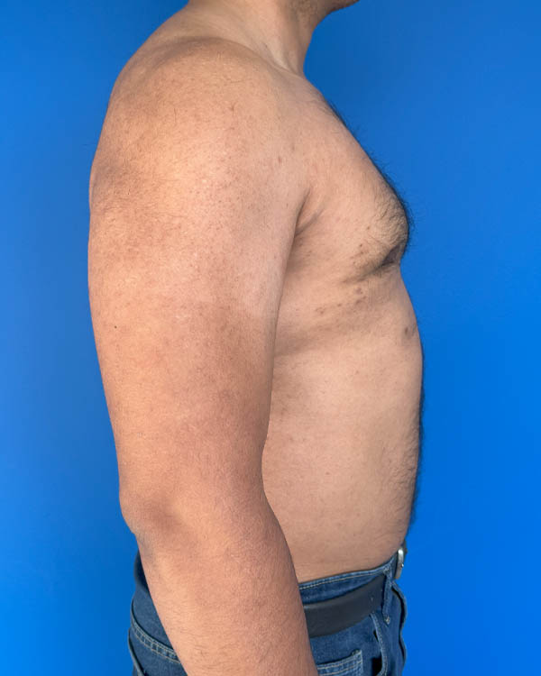 Gynecomastia case #3999