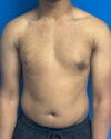 Gynecomastia case #4010