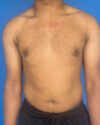 Gynecomastia case #4010