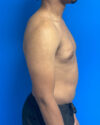 Gynecomastia case #4010