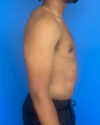 Gynecomastia case #4010