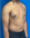Gynecomastia case #4010