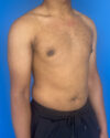 Gynecomastia case #4010