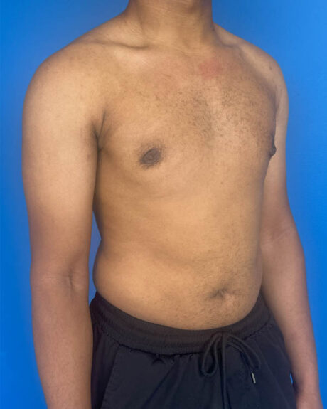 Gynecomastia case #4010