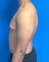 Gynecomastia case #4010