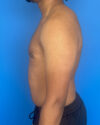 Gynecomastia case #4010