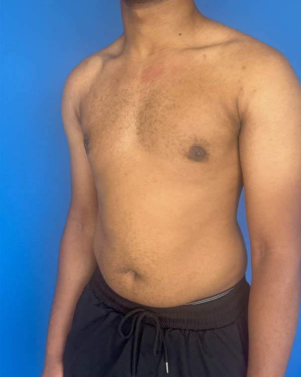 Gynecomastia case #4010