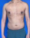 Gynecomastia case #4021