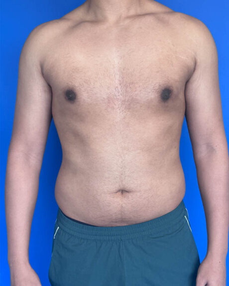 Gynecomastia case #4021