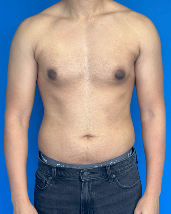 Gynecomastia case #4021