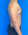 Gynecomastia case #4021