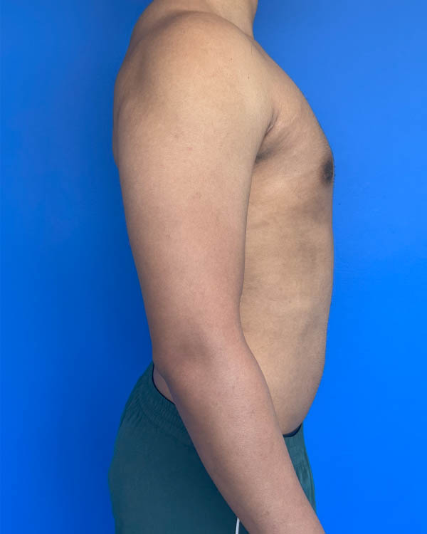 Gynecomastia case #4021