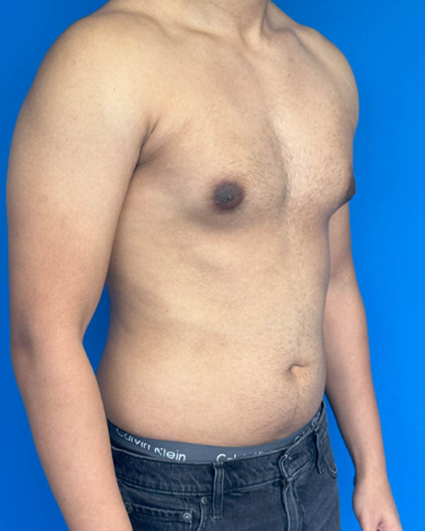 Gynecomastia case #4021