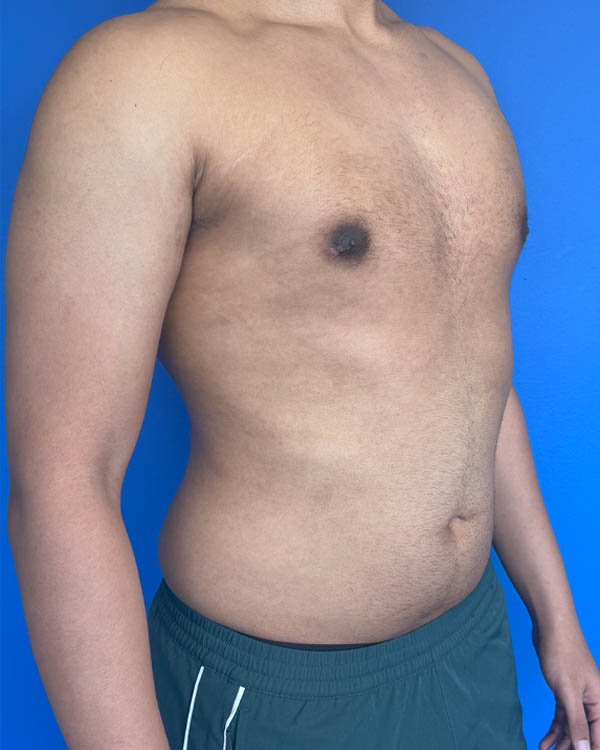 Gynecomastia case #4021