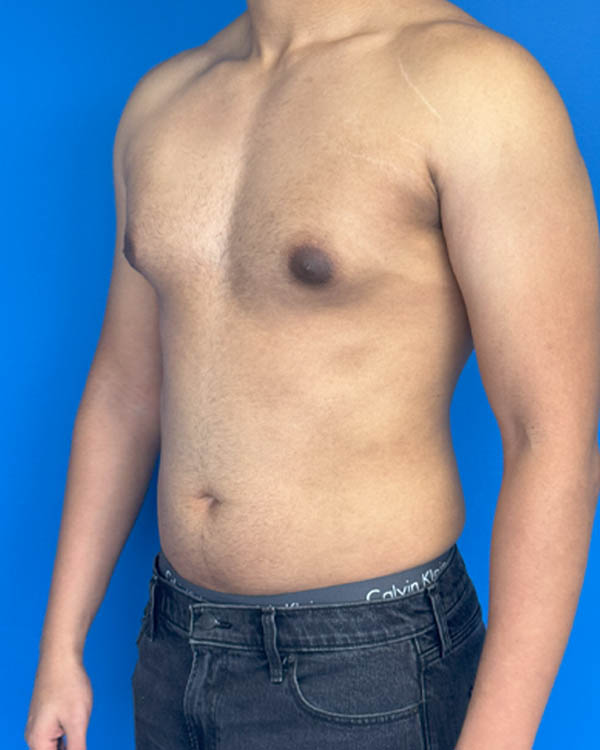 Gynecomastia case #4021