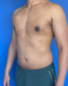Gynecomastia case #4021
