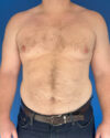 Gynecomastia case #4031
