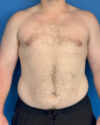 Gynecomastia case #4031