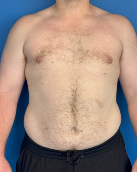 Gynecomastia case #4031