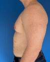 Gynecomastia case #4031
