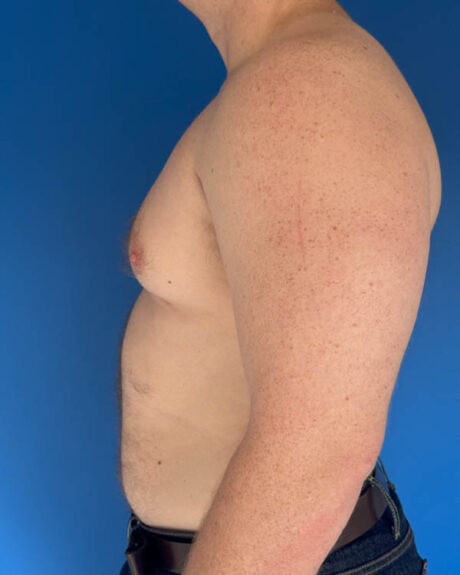Gynecomastia case #4031