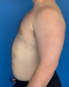 Gynecomastia case #4031