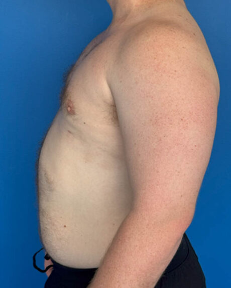 Gynecomastia case #4031