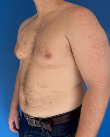 Gynecomastia case #4031