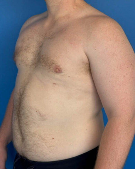Gynecomastia case #4031