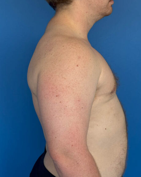 Gynecomastia case #4031