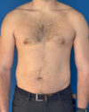 Gynecomastia case #4042