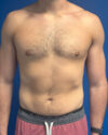 Gynecomastia case #4042